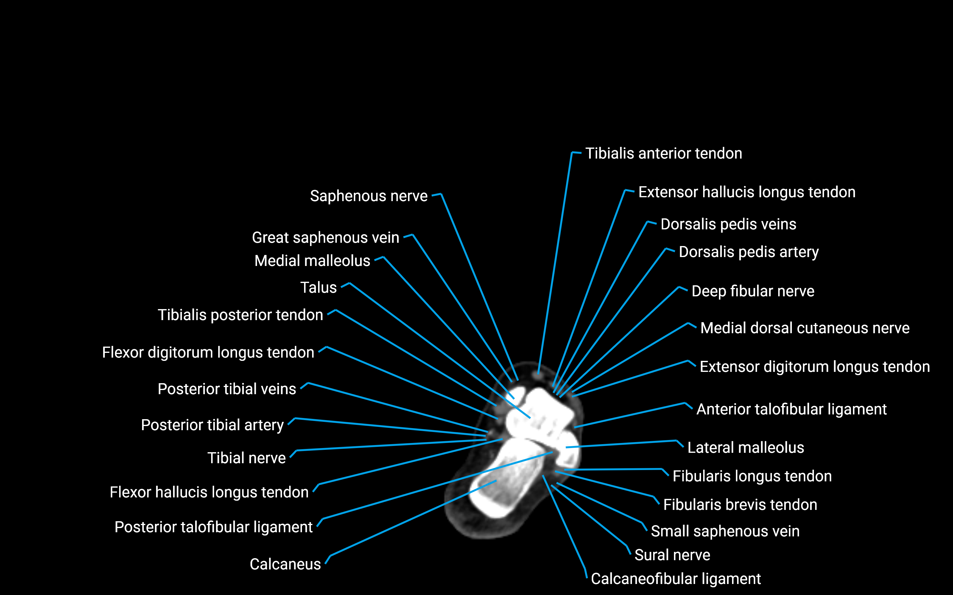 CT Lower leg axial cross sectional anatomy labelled image 168 (2).png